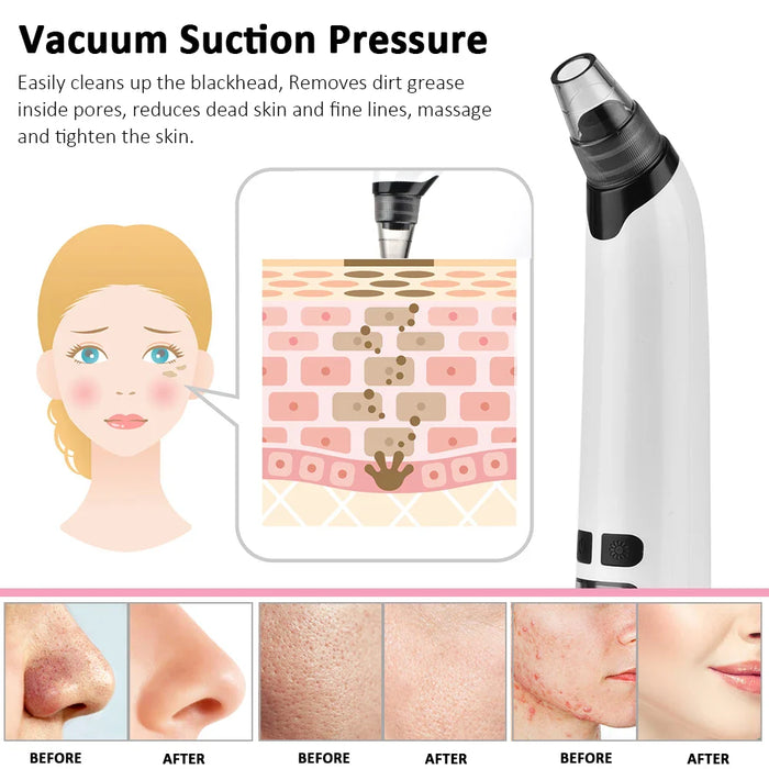 Blackhead Remover Vacuum For Deep Cleaning