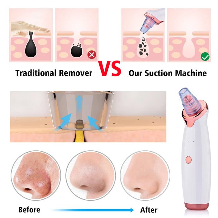 Electric Blackhead Remover Vacuum