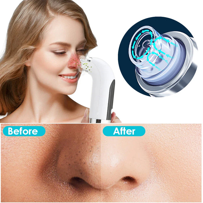 3 In 1 Blackhead Vacuum Cleaner For Clear Skin